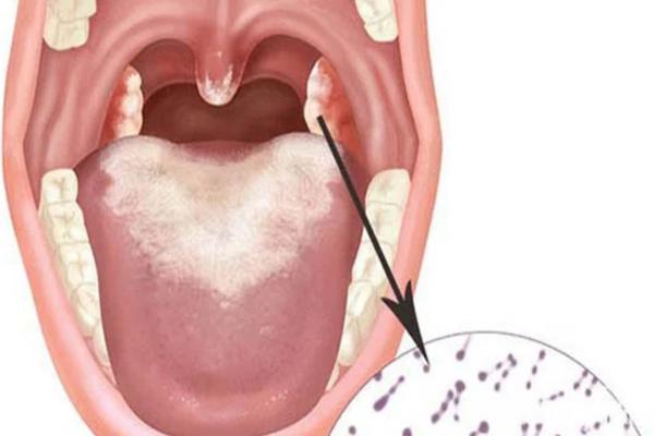 Bệnh bạch hầu ở mũi họng