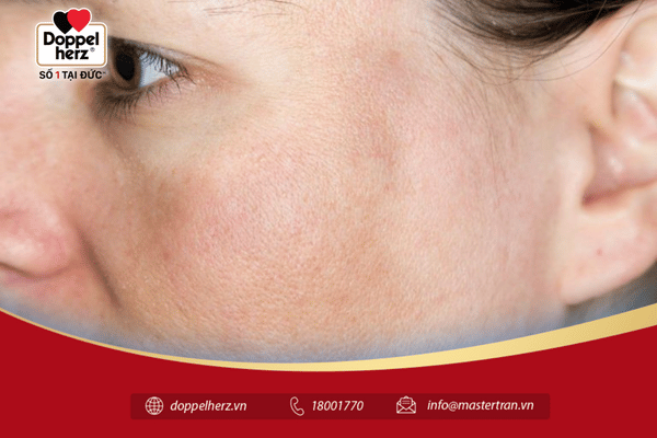 Dấu hiệu bị nám da mặt dễ nhận biết nhất là da xuất hiện những vùng sạm màu