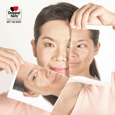 Cách phân biệt nám và tàn nhang