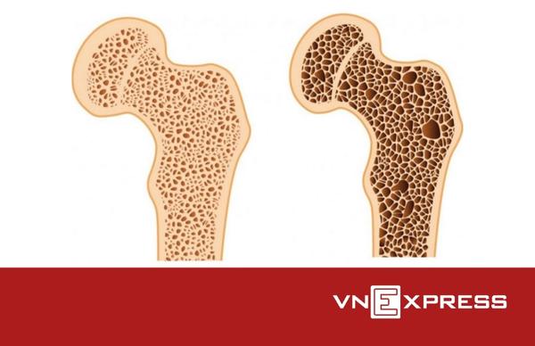 Vì sao phụ nữ mãn kinh bị loãng xương?