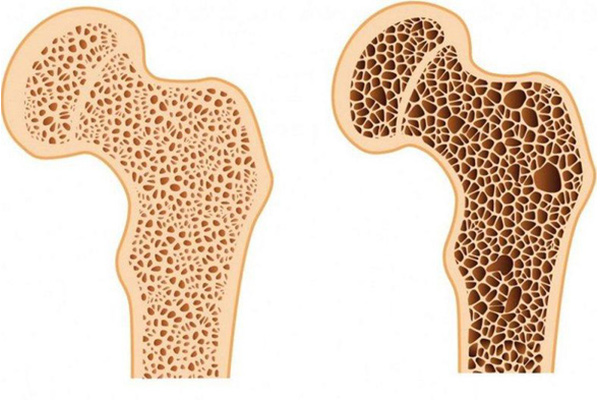 Hình ảnh so sánh xương bình thường (bên trái) và loãng xương - Ảnh: Healthcare