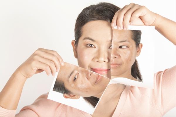 cách làm mặt nạ nha đam trị nám