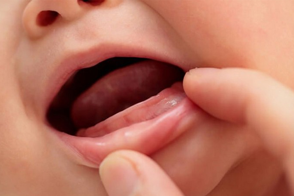Trẻ chậm mọc răng có phải thiếu canxi?