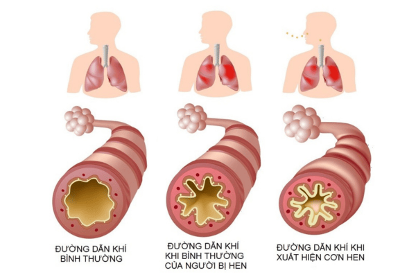 Đường dẫn khí của người bị bệnh hen suyễn