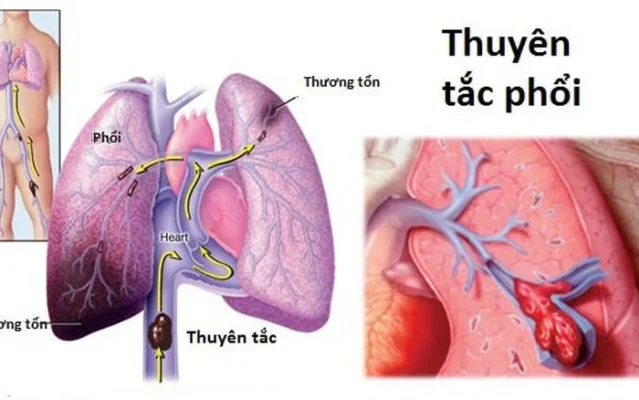 Thuyên tắc động mạch phổi là gì