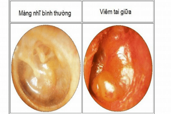 Các loại viêm tai giữa