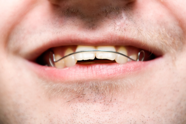 Khớp cắn ngược hay móm là gì