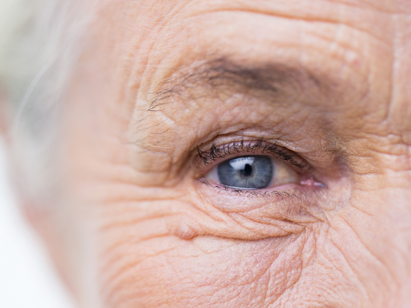 Mi mắt rũ xuống và tật lộn mi khiến mắt chúng ta chảy nước mắt nhiều hơn