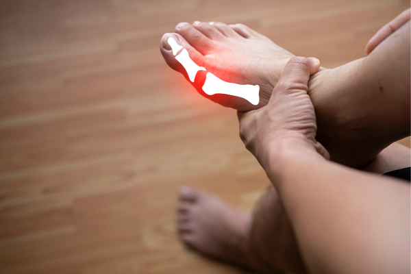 Những lưu ý để góp phần giảm bớt các cơn đau gút mãn tính