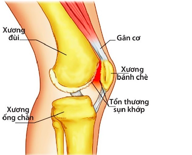khớp thiếu linh hoạt