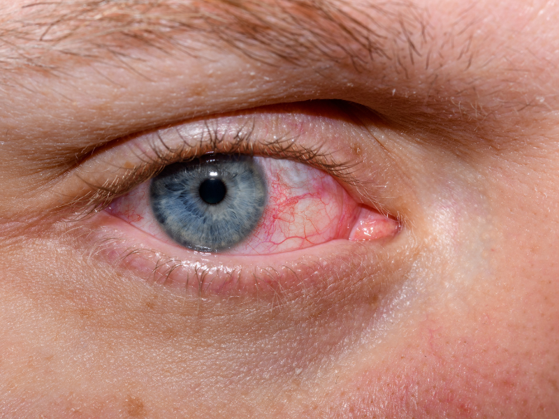 Vi khuẩn là tác nhân chính gây nhiễm trùng mắt dẫn đến chảy nước mắt liên tục