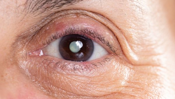 Khi võng mạc bị bong một phần, người bệnh có thể gặp tình trạng mắt mờ