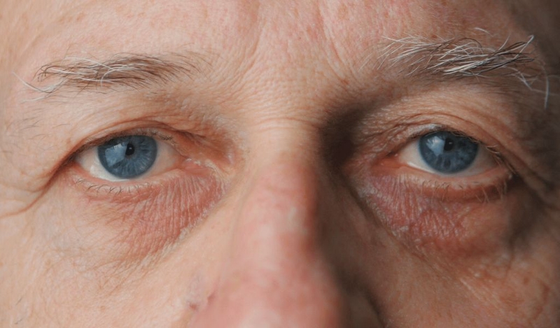 Mặt bị cườm khô là bệnh gì?